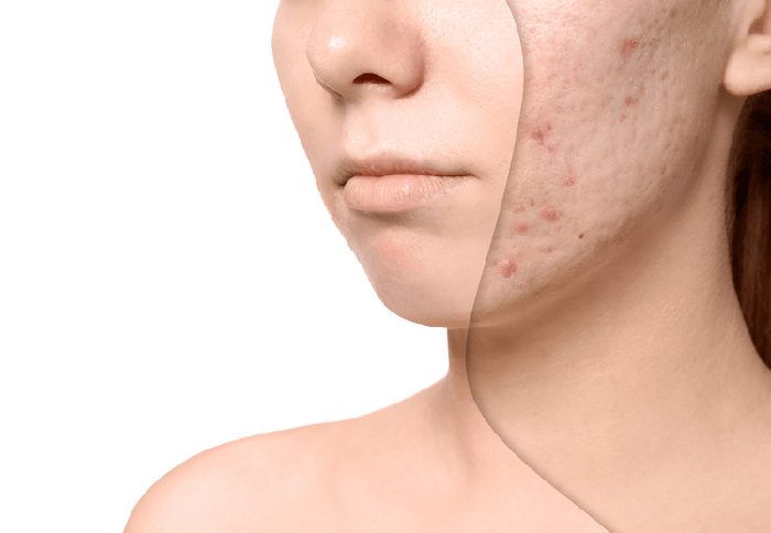 Axit Hyaluronic có thể giúp trị mụn thế nào 2023? 3 Axit Hyaluronic