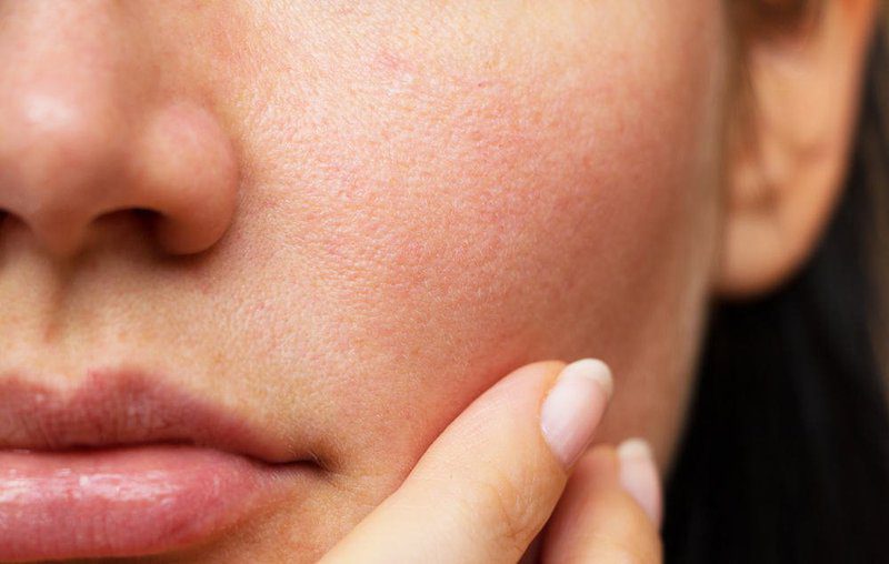 Cách phân biệt 2 loại da khô và da thiếu nước 2 da thiếu nước