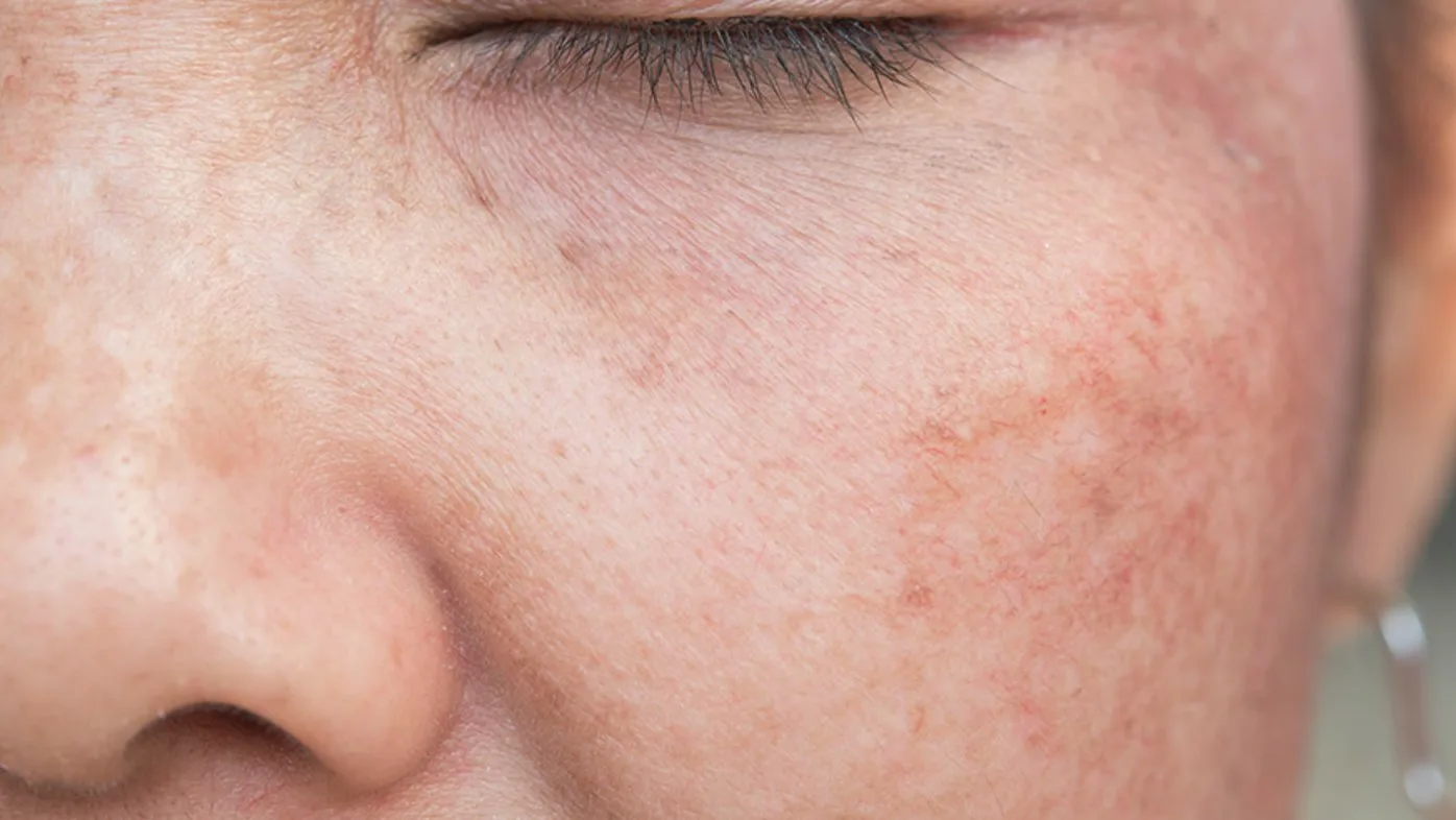 Can skin damage be reversed HN3038 iStock 915102062 Sized