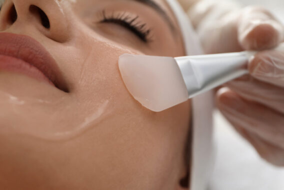 Da nhạy cảm có nên peel da không 2024 ? 3 peel