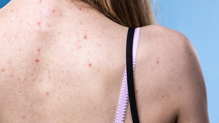 Làm thế nào để loại bỏ mụn lưng 2024 2 mụn lưng