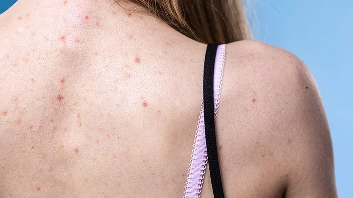 Back acne