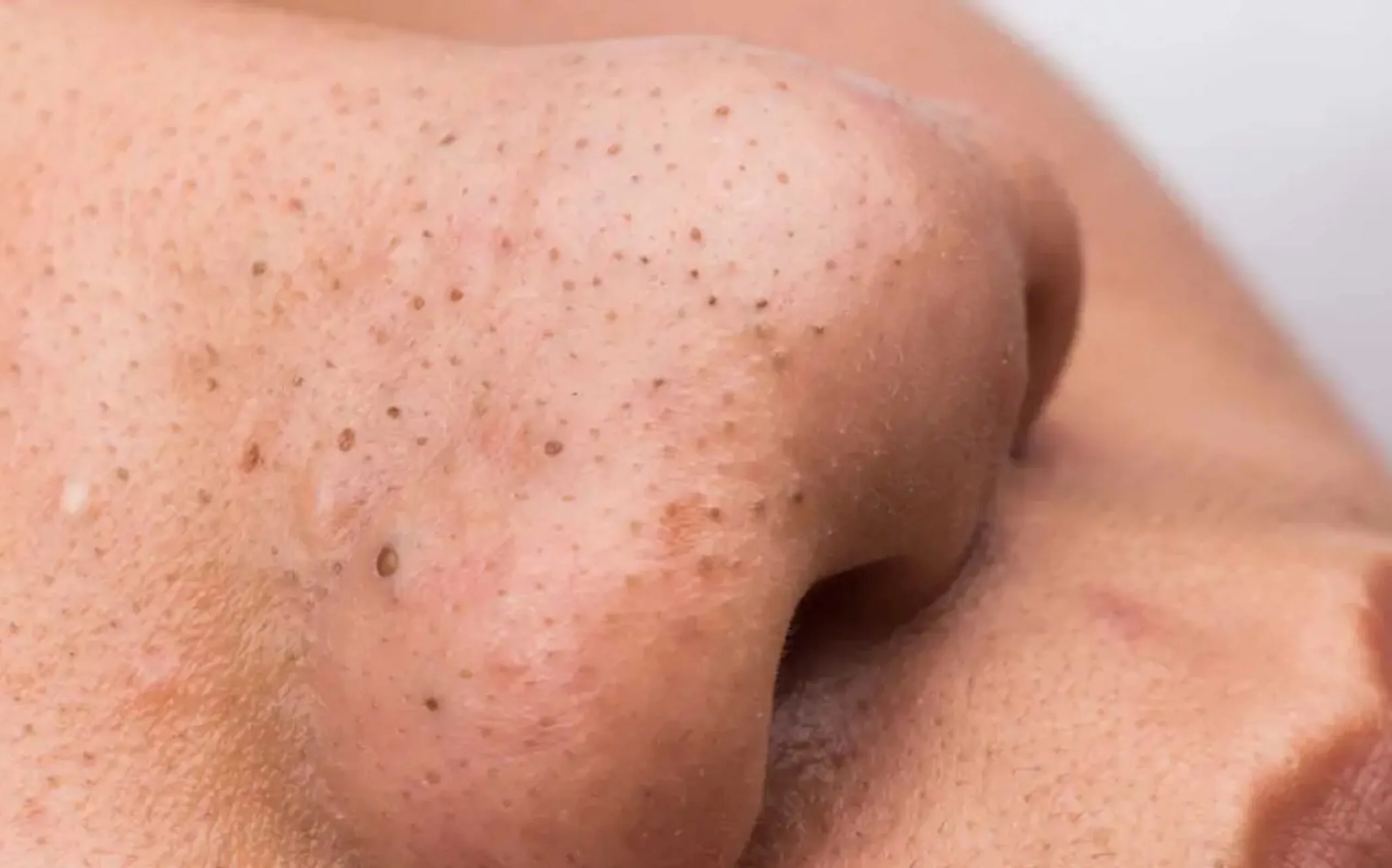 blackhead scaled