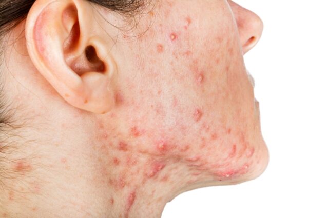 Mụn trứng cá dạng nang