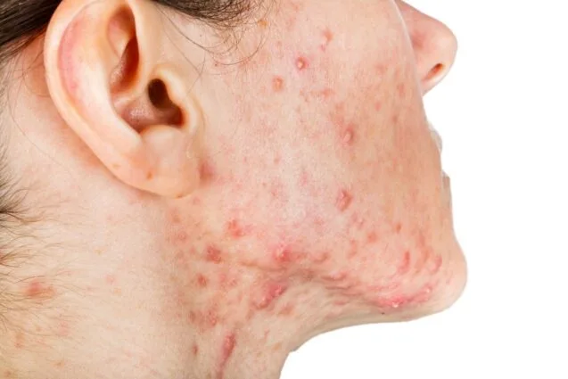 cystic acne