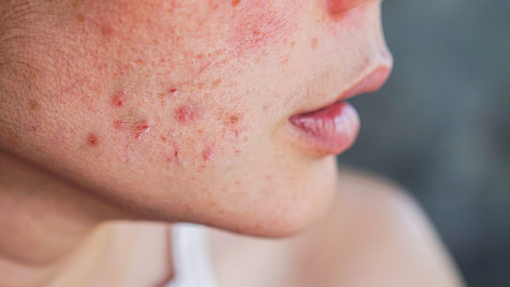 Acne