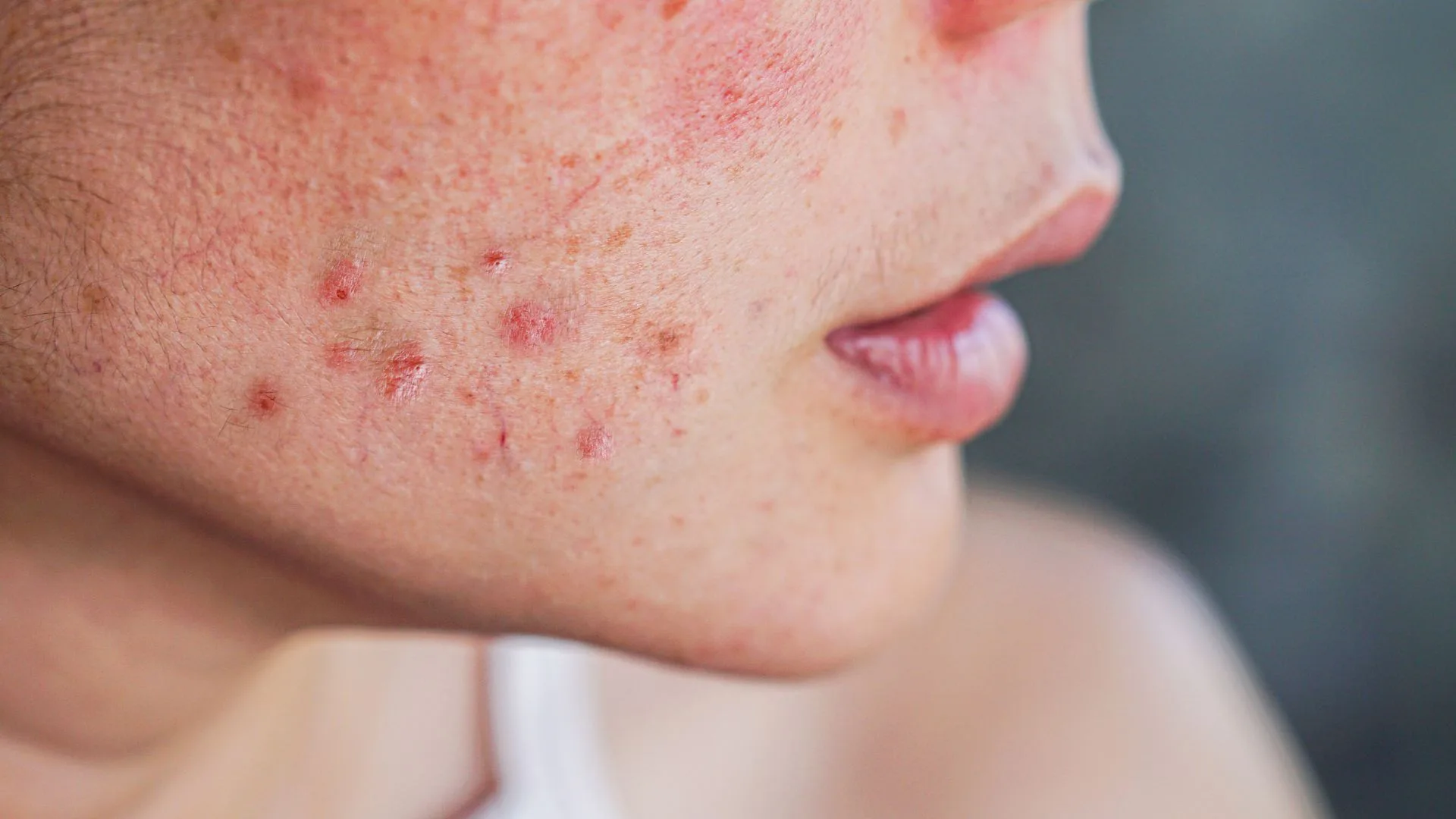 Acne
