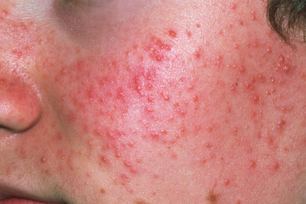 acne