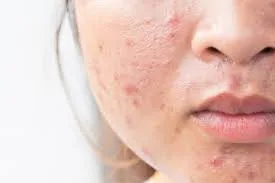 pimple