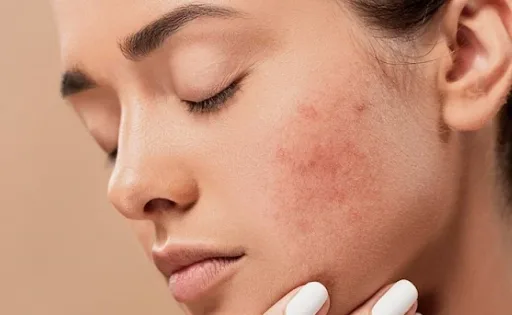 Serum dưỡng ẩm Dr.Belter cho da mụn – Cấp nước mà không gây bí tắc lỗ chân lông 6 Serum duong am